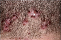 bumps on the scalp - folliculitis